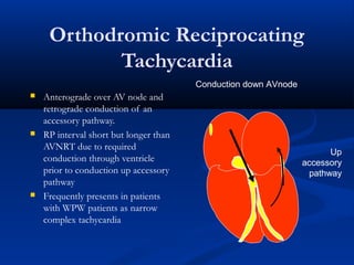 Orthodromic Reciprocating
Tachycardia
 Anterograde over AV node and
retrograde conduction of an
accessory pathway.
 RP interval short but longer than
AVNRT due to required
conduction through ventricle
prior to conduction up accessory
pathway
 Frequently presents in patients
with WPW patients as narrow
complex tachycardia
Up
accessory
pathway
Conduction down AVnode
 