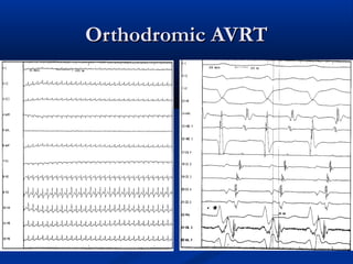 Orthodromic AVRTOrthodromic AVRT
 
