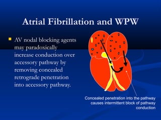 Atrial Fibrillation and WPW
 AV nodal blocking agents
may paradoxically
increase conduction over
accessory pathway by
removing concealed
retrograde penetration
into accessory pathway.
Concealed penetration into the pathway
causes intermittent block of pathway
conduction
 