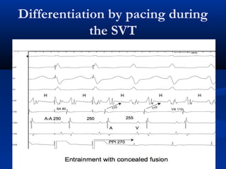 Differentiation by pacing during
the SVT
 