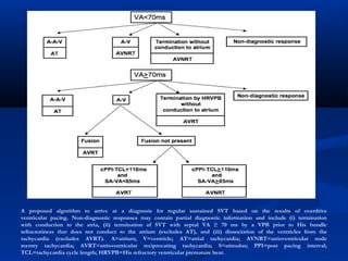A proposed algorithm to arrive at a diagnosis for regular sustained SVT based on the results of overdrive
ventricular pacing. Non-diagnostic responses may contain partial diagnostic information and include (i) termination
with conduction to the atria, (ii) termination of SVT with septal VA ≥ 70 ms by a VPB prior to His bundle
refractoriness that does not conduct to the atrium (excludes AT), and (iii) dissociation of the ventricles from the
tachycardia (excludes AVRT). A=atrium; V=ventricle; AT=atrial tachycardia; AVNRT=atrioventricular node
reentry tachycardia; AVRT=atrioventricular reciprocating tachycardia; S=stimulus; PPI=post pacing interval;
TCL=tachycardia cycle length; HRVPB=His refractory ventricular premature beat.
 