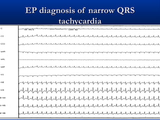 EP diagnosis of narrow QRSEP diagnosis of narrow QRS
tachycardiatachycardia
 