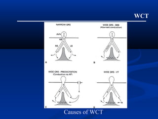 WCT
Causes of WCT
 