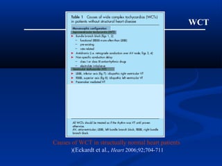 WCT
Causes of WCT in structually normal heart patients
(Eckardt et al., Heart 2006;92;704-711(
 