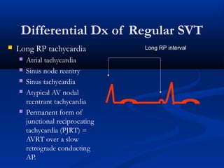 Differential Dx of Regular SVT
 Long RP tachycardia
 Atrial tachycardia
 Sinus node reentry
 Sinus tachycardia
 Atypical AV nodal
reentrant tachycardia
 Permanent form of
junctional reciprocating
tachycardia (PJRT) =
AVRT over a slow
retrograde conducting
AP.
Long RP interval
 
