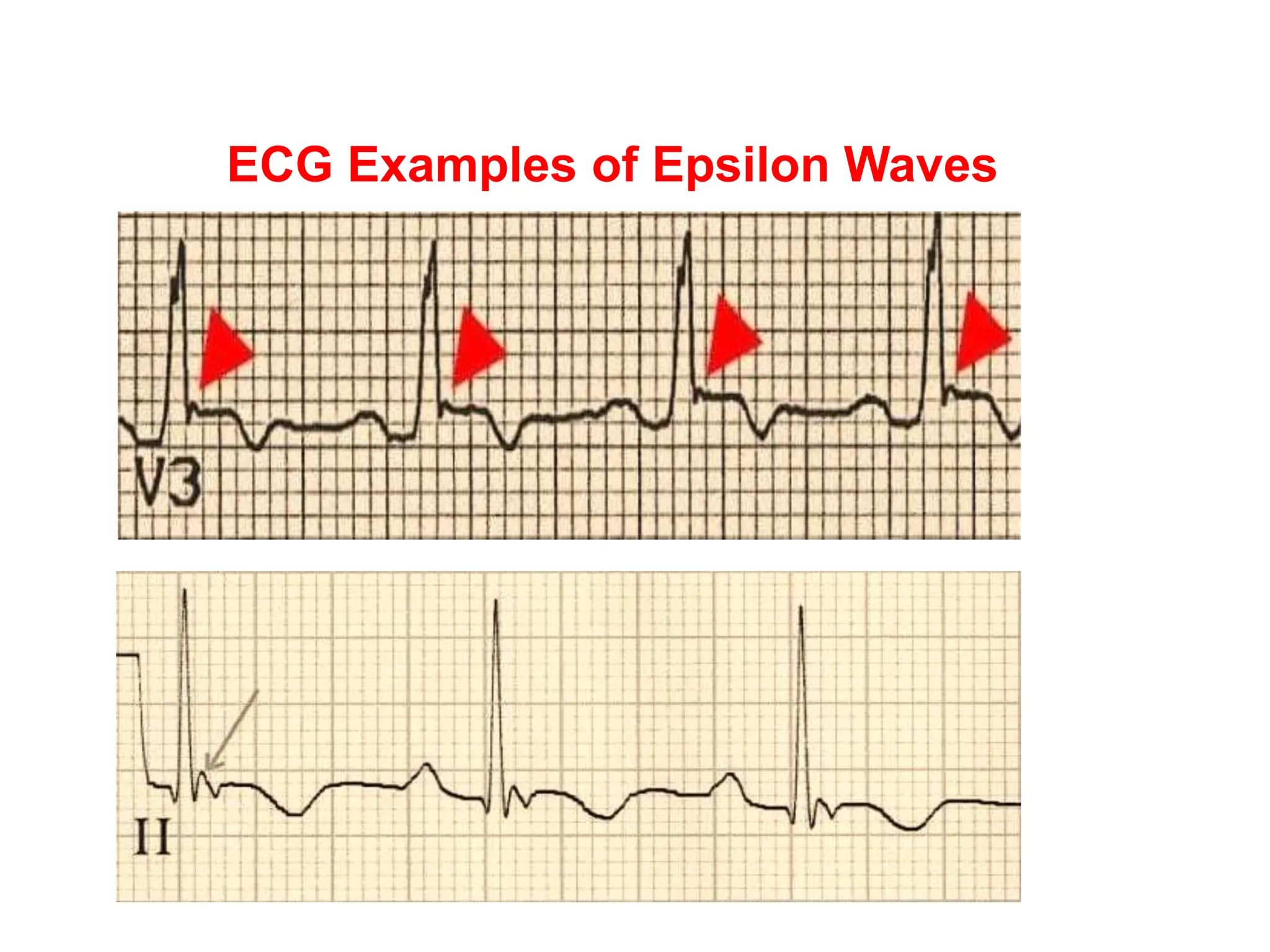 EPSILON WAVE IN ECG AND ITS INTERPRETATION PPTX EPSILON WAVE IN ECG AND ITS INTERPRETATION PPTX