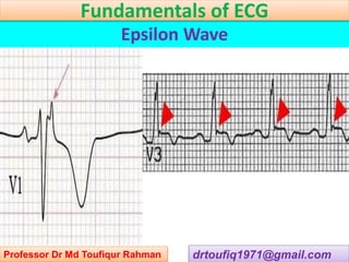 drtoufiq1971@gmail.com
Epsilon Wave
Professor Dr Md Toufiqur Rahman
Fundamentals of ECG
 