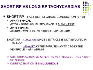 Long Rp Example Comprehensive Electrophysiological Study in Supraventricular ...