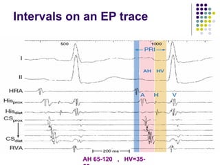 Comprehensive Electrophysiological Study in Supraventricular ...