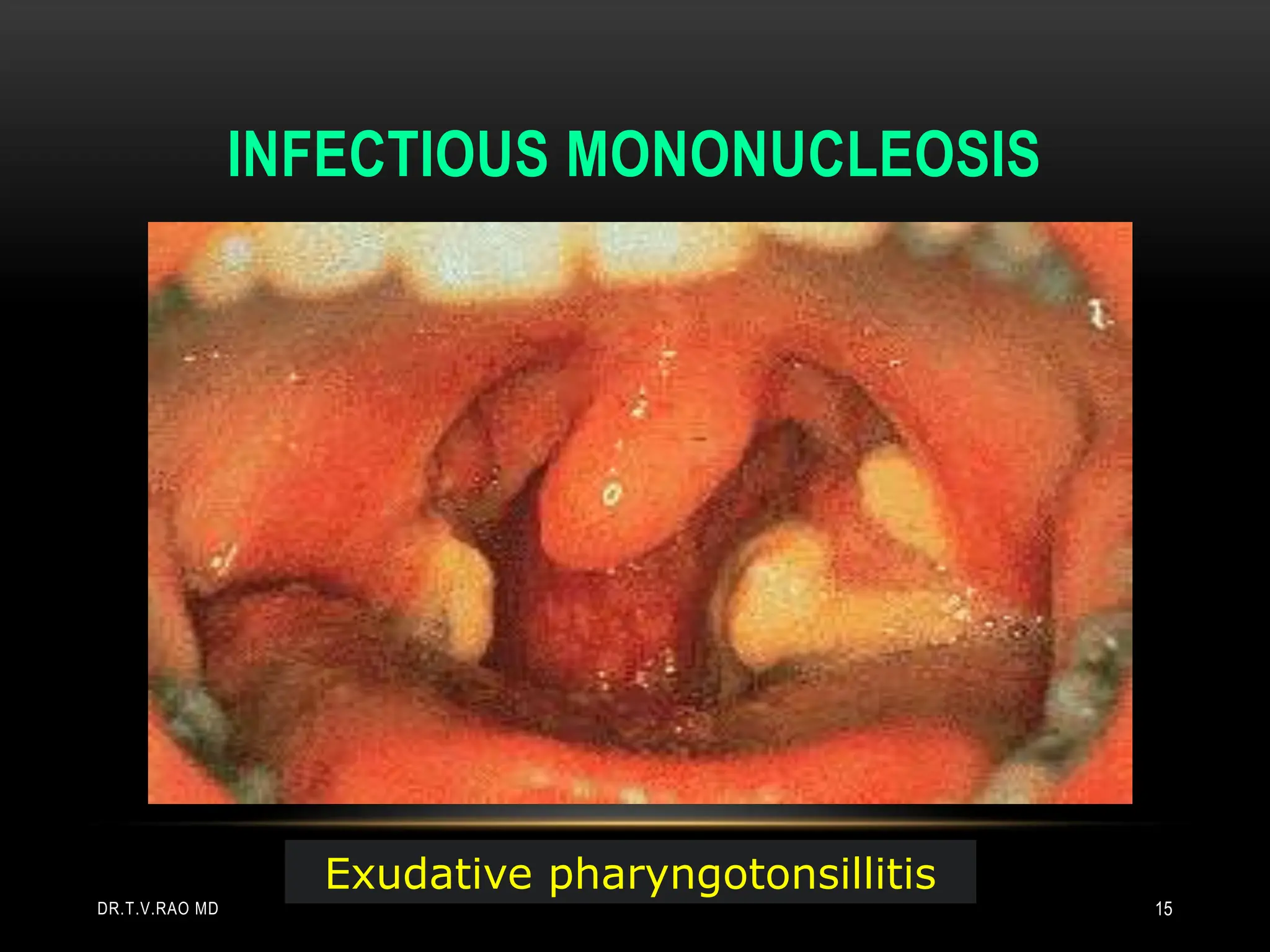 INFECTIOUS MONONUCLEOSIS
Exudative pharyngotonsillitis
DR.T.V.RAO MD 15