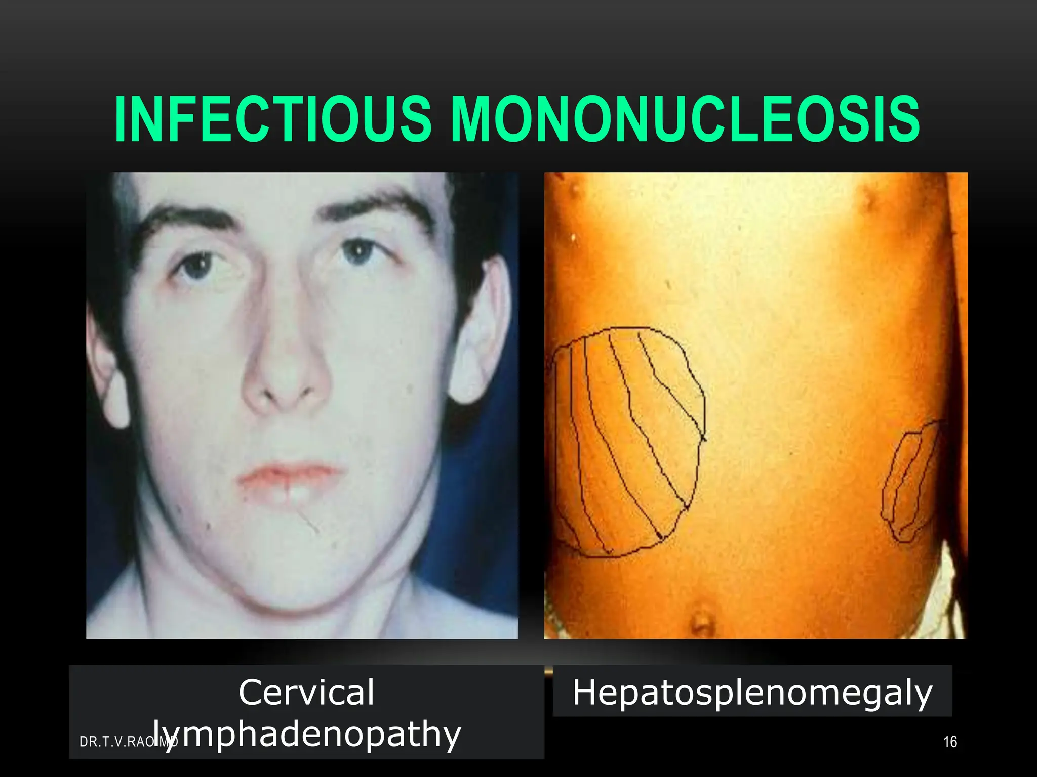 INFECTIOUS MONONUCLEOSIS
Hepatosplenomegaly
Cervical
lymphadenopathy
DR.T.V.RAO MD 16