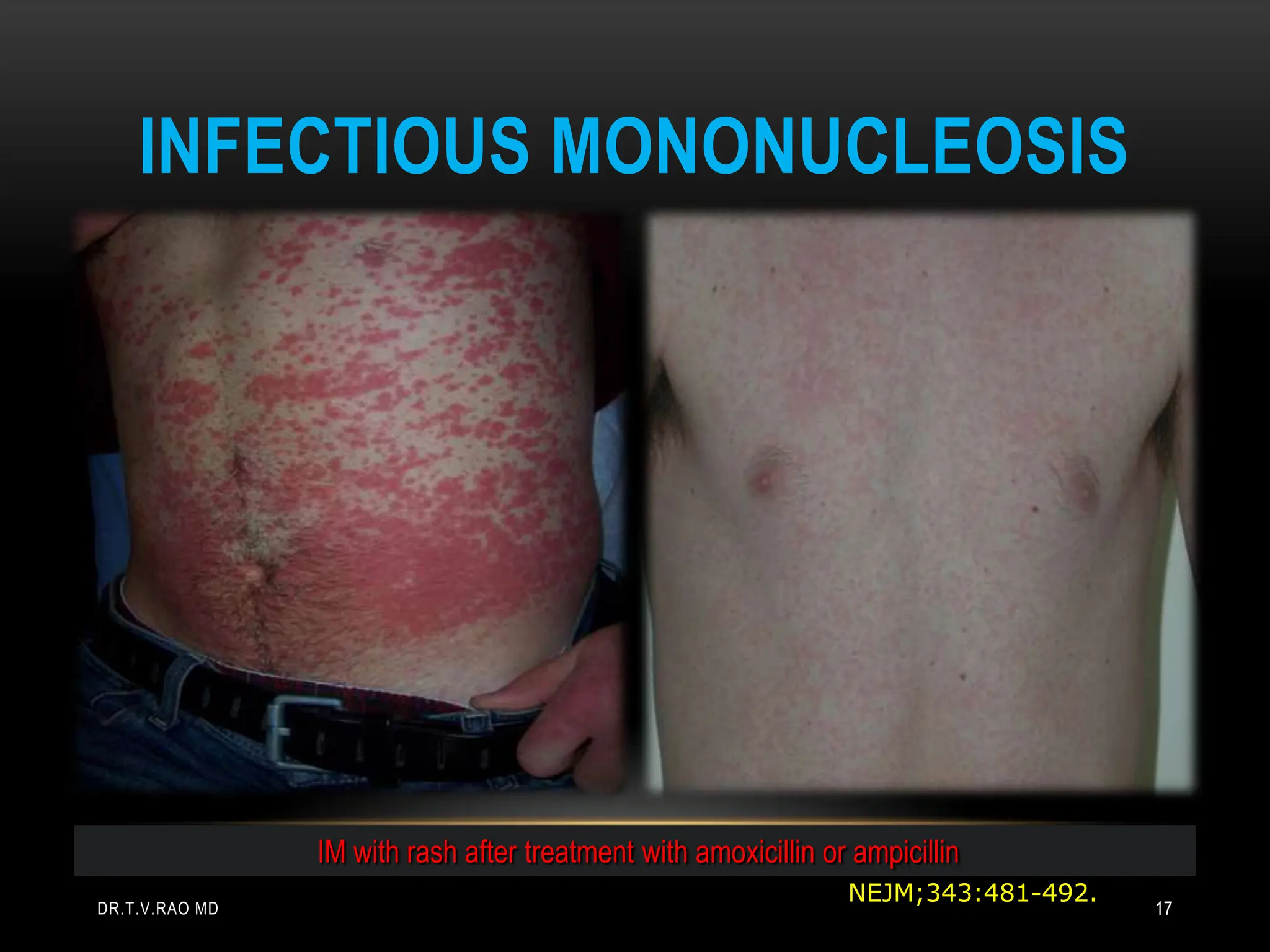 INFECTIOUS MONONUCLEOSIS
IM with rash after treatment with amoxicillin or ampicillin
NEJM;343:481-492.
DR.T.V.RAO MD 17