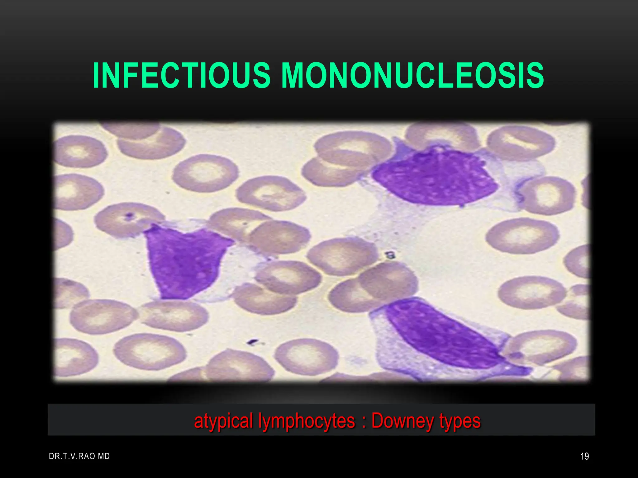 INFECTIOUS MONONUCLEOSIS
atypical lymphocytes : Downey types
DR.T.V.RAO MD 19