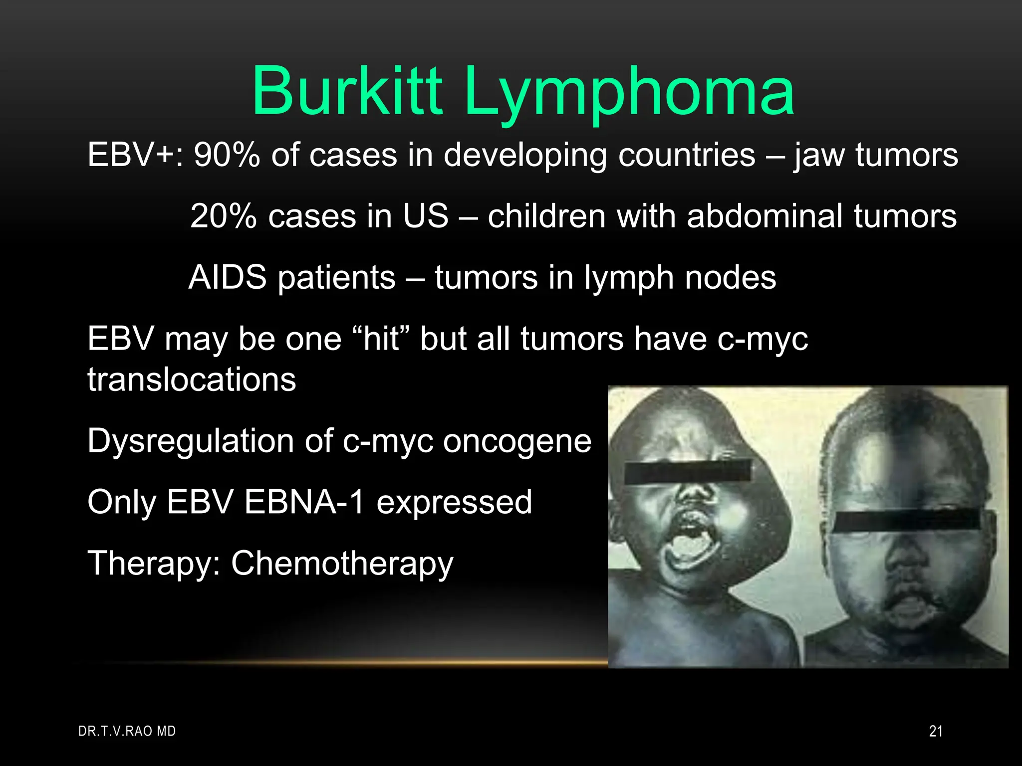 EBV+: 90% of cases in developing countries – jaw tumors
20% cases in US – children with abdominal tumors
AIDS patients – tumors in lymph nodes
EBV may be one “hit” but all tumors have c-myc
translocations
Dysregulation of c-myc oncogene
Only EBV EBNA-1 expressed
Therapy: Chemotherapy
Burkitt Lymphoma
DR.T.V.RAO MD 21