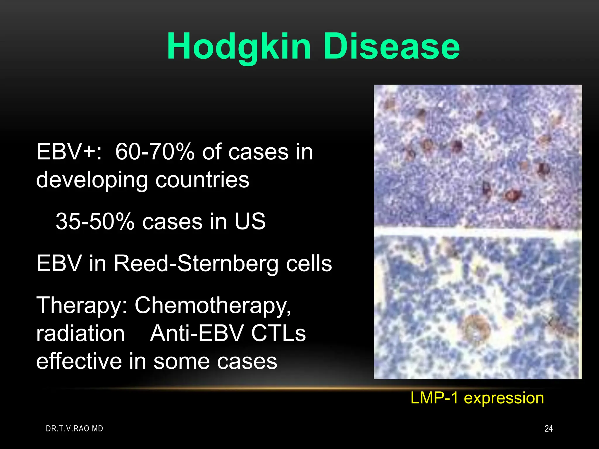 EBV+: 60-70% of cases in
developing countries
35-50% cases in US
EBV in Reed-Sternberg cells
Therapy: Chemotherapy,
radiation Anti-EBV CTLs
effective in some cases
Hodgkin Disease
LMP-1 expression
DR.T.V.RAO MD 24
