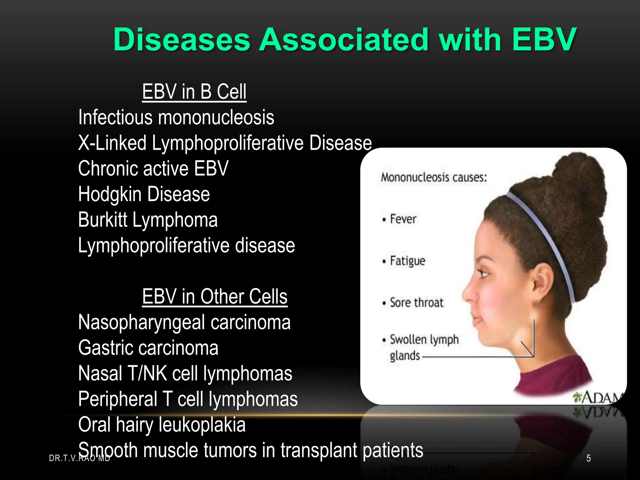EBV in B Cell
Infectious mononucleosis
X-Linked Lymphoproliferative Disease
Chronic active EBV
Hodgkin Disease
Burkitt Lymphoma
Lymphoproliferative disease
EBV in Other Cells
Nasopharyngeal carcinoma
Gastric carcinoma
Nasal T/NK cell lymphomas
Peripheral T cell lymphomas
Oral hairy leukoplakia
Smooth muscle tumors in transplant patients
Diseases Associated with EBV
DR.T.V.RAO MD 5