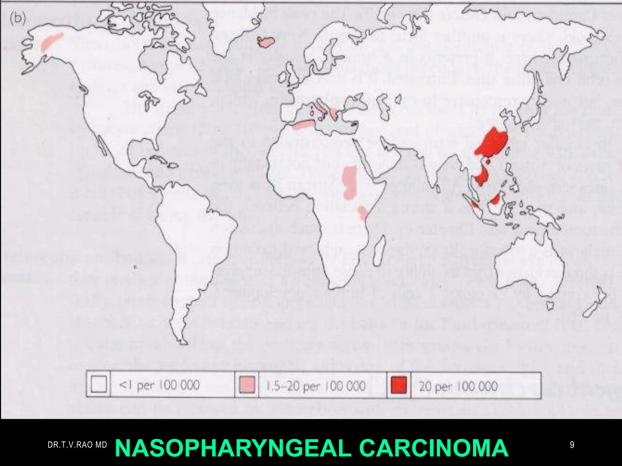 NASOPHARYNGEAL CARCINOMA
DR.T.V.RAO MD 9