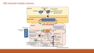 EBV induced multiple sclerosis
 