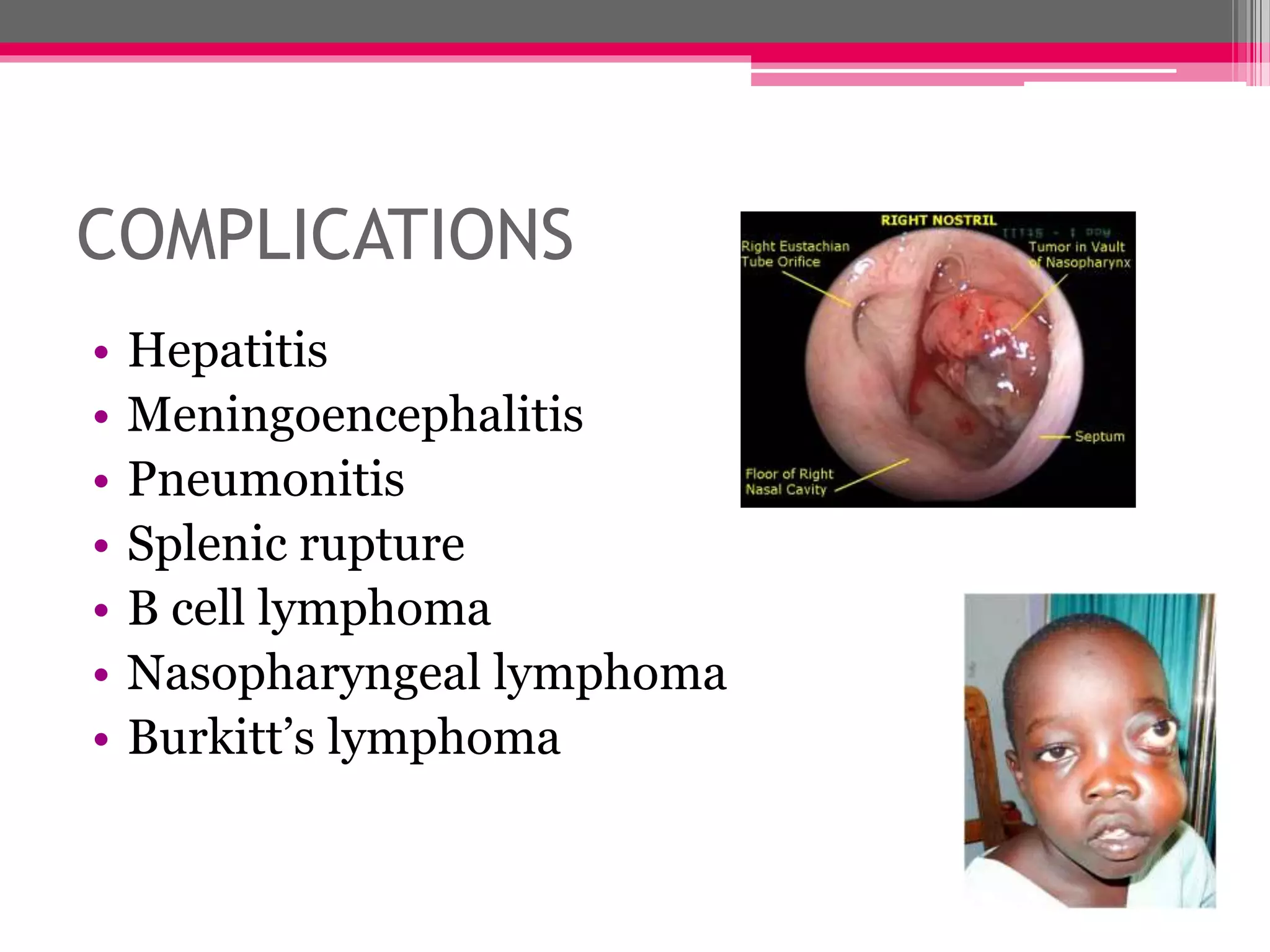 COMPLICATIONS
• Hepatitis
• Meningoencephalitis
• Pneumonitis
• Splenic rupture
• B cell lymphoma
• Nasopharyngeal lymphoma
• Burkitt’s lymphoma