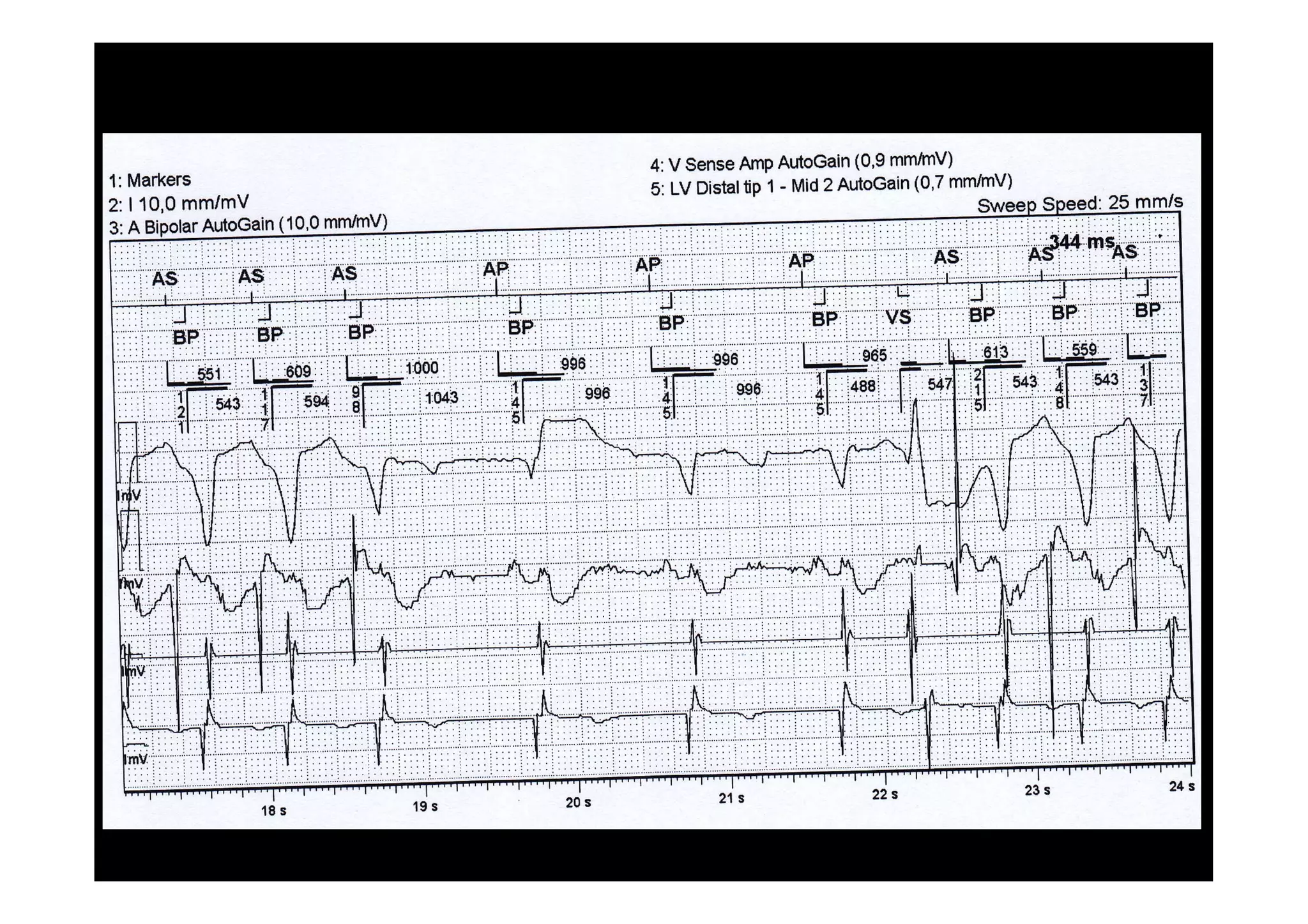 Ventricular Safety StandbY
1:Markers
4: V Sense AmP Autocain (0,9 mm/l11V)
5: LV Distaltip 1 - Mid 2 AutoGain (0,7 mmlnV)
2: 110,0 mmlmV
3: A Bioolar AutoGain (10,0 Eq4nV)
Unify QuadrarM 3251-4OQ CRT-D (1064845 prC'E'9A)
PCS (#12053842 3330 v21'1'2 rev 1)
Freeze CaPture Page 1 of 'l
50d2016 12"23
 
