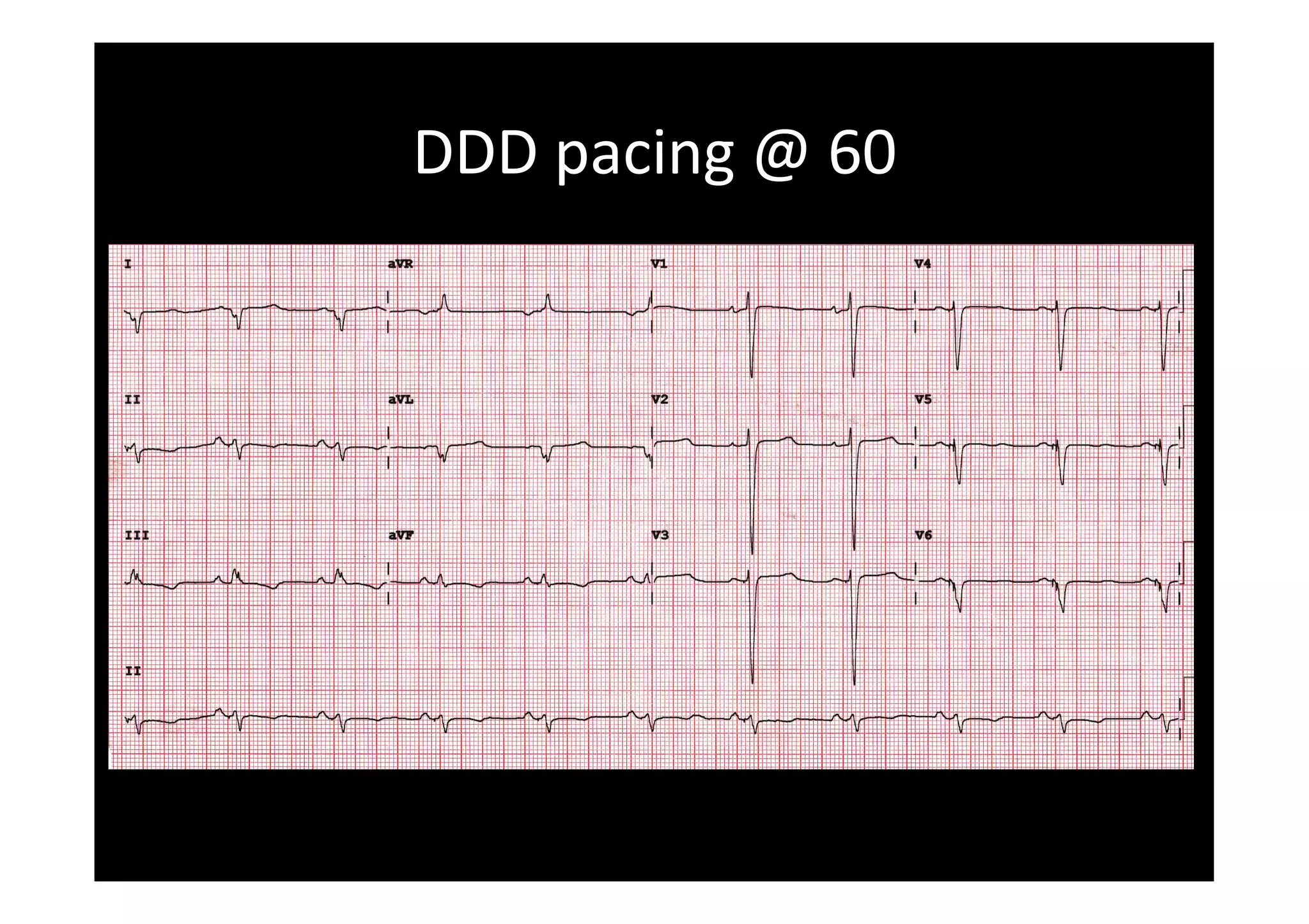 DDD	
  pacing	
  @	
  60	
  
 