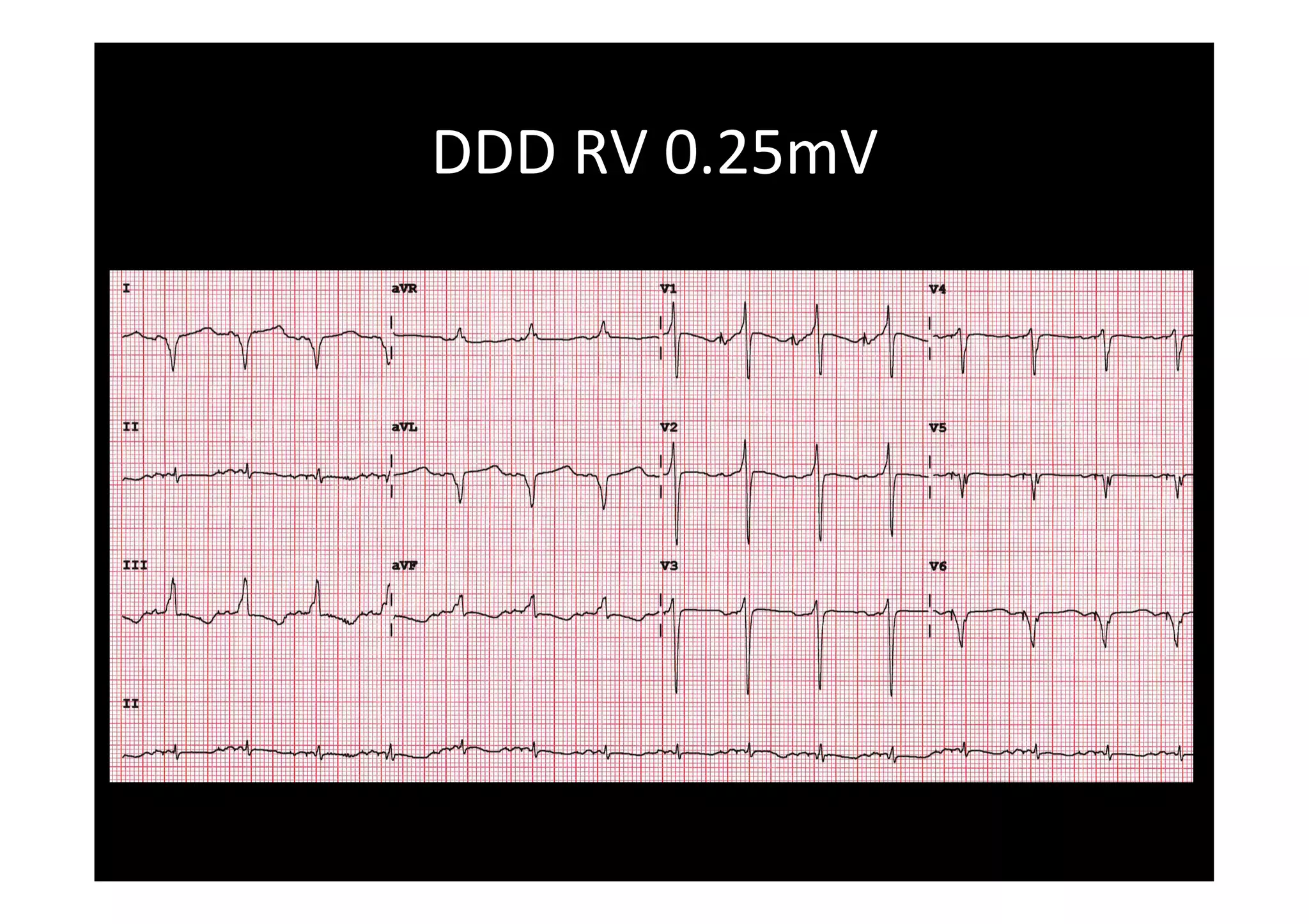 DDD	
  RV	
  0.25mV	
  
 