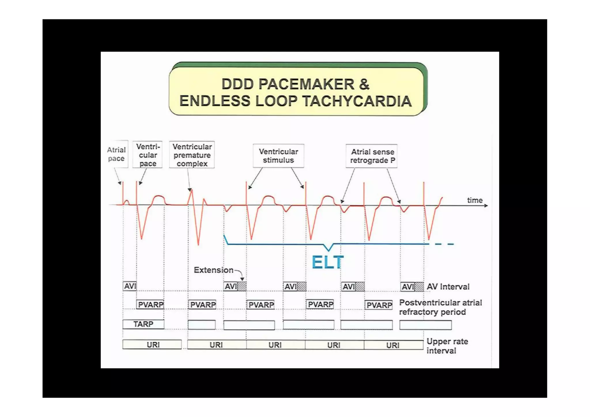 Pacemaker Mediated Tachycardia... or not?