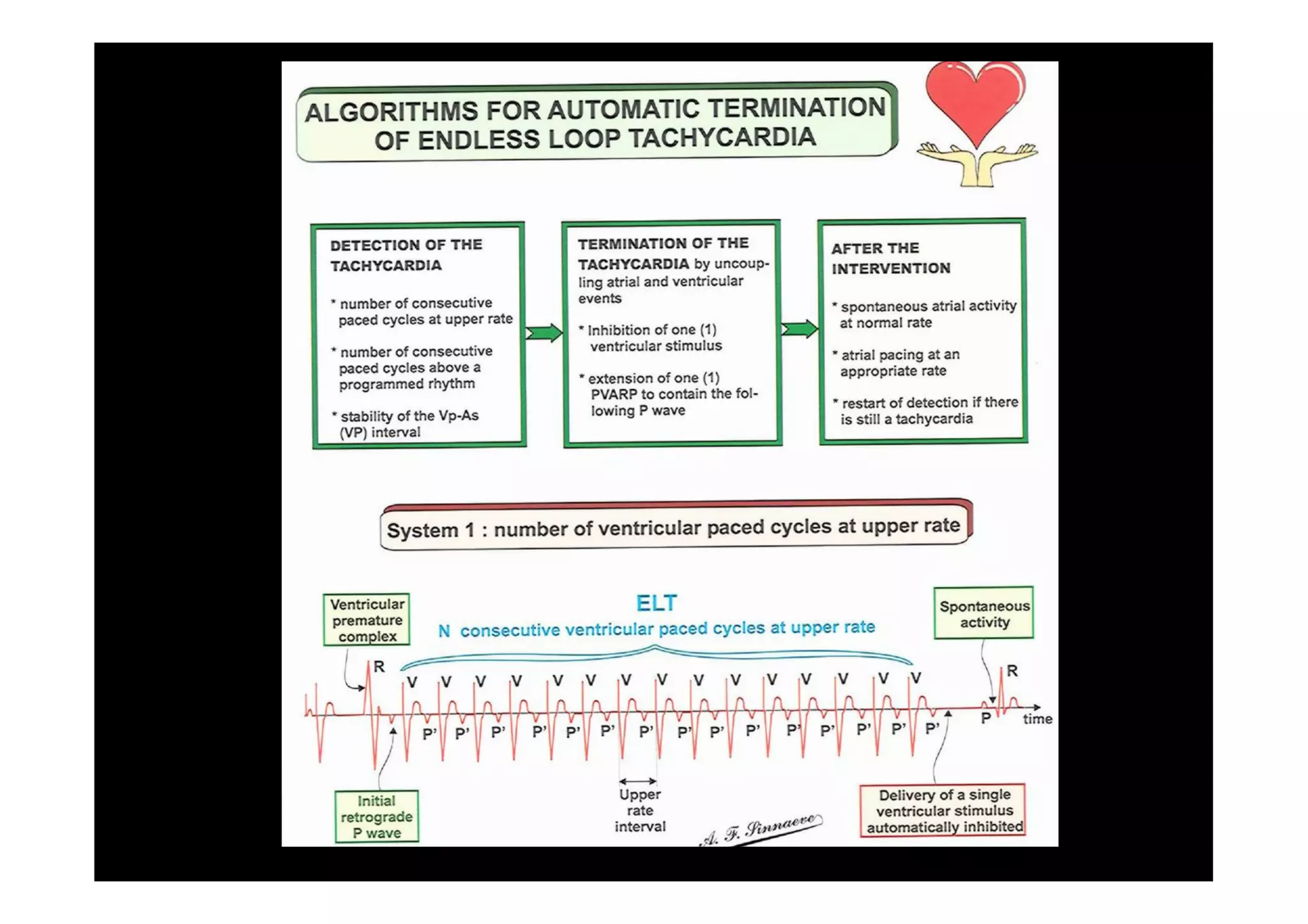 Pacemaker Mediated Tachycardia... or not?