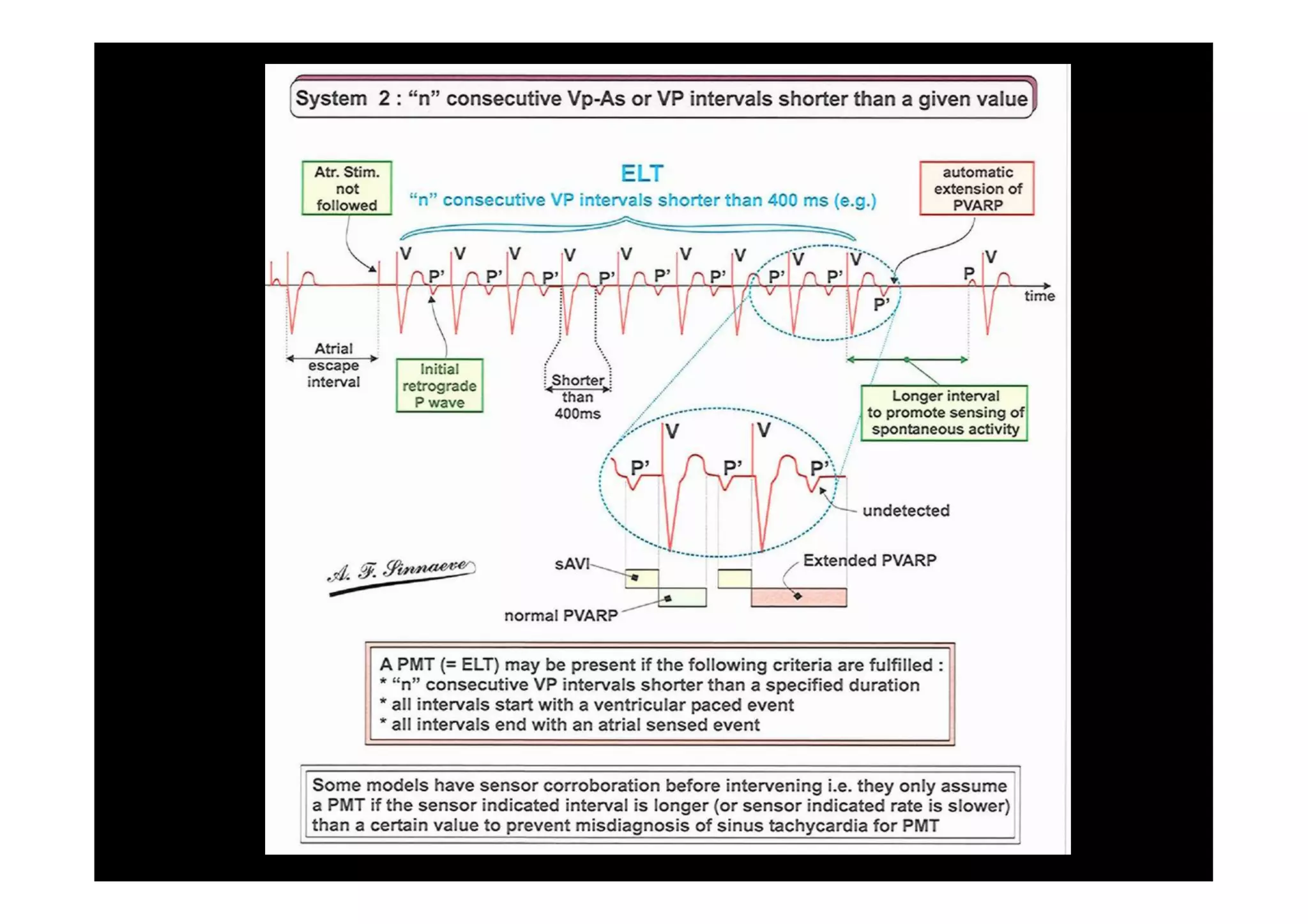 Pacemaker Mediated Tachycardia... or not?