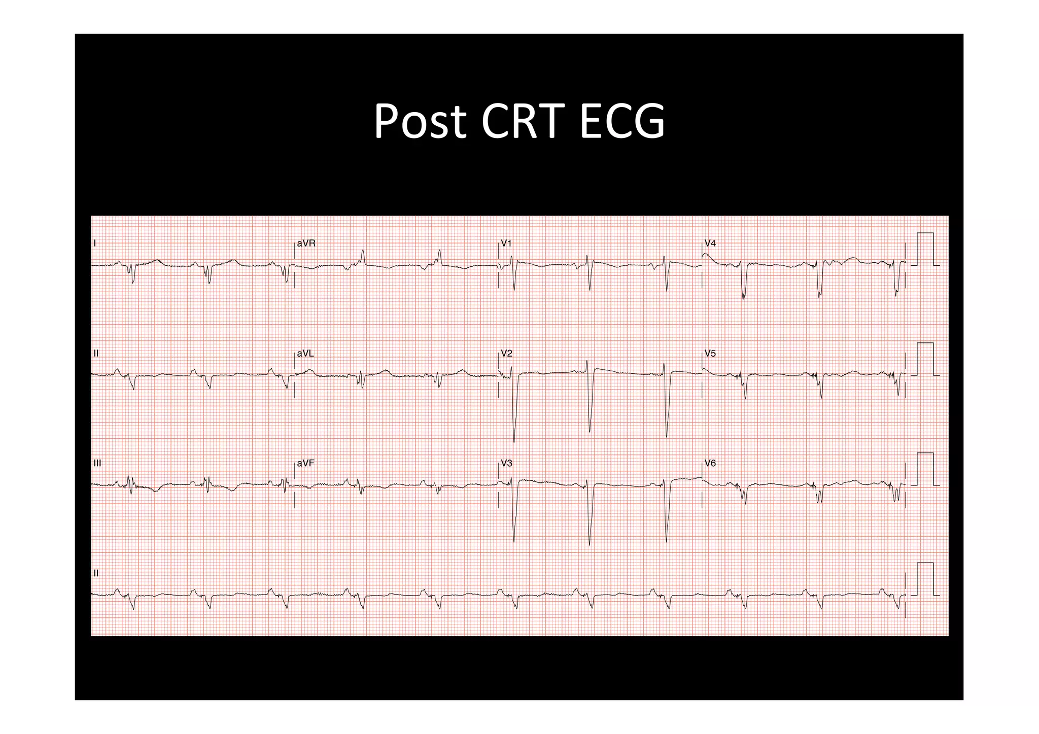 Post	
  CRT	
  ECG	
  
Name: chua chai teen, MRN: S0147783H Age: 61 Yrs DOB: 24/12/1954 Gender: Female Ethnic origin: Unknown Date: 03/10/2016 20:50:14
Height: Unknown Weight: Unknown REGULAR VENTRICULAR PACING
NO FURTHER ANALYSIS MADE BECAUSE OF PACEMAKER RHYTHM.
NO OTHER FINDINGS
SUMMARY: SOME ABNORMALITIES NO LONGER PRESENT
COMPARED TO ECG(S) OF 03/10/2016 14:40:49
PR: 0 P Axis: 53
QRS Dur: 128 QRS Axis: -171
QT: 482 T Axis: -25
QTc: 494 HR: 63
QT Disp: 124 BP:
Requested By: Taken By: HNUC
ECG Cart Serial Number: Location: US81305433
Undefined: BLK4,LVL7/ECG04 Undefined:
DX:
RX:
Previous ECG: 03/10/2016 14:40:49 (Abnormal ECG) Abnormal ECG
PRELIMINARY REPORT - PHYSICIAN MUST REVIEW
I aVR V1 V4
II aVL V2 V5
III aVF V3 V6
II
SHS - Singhealth - NHC - National Heart Centre - W47B - Ward 47B F 0.5 - 100 Hz 25 mm/sec 10 mm/mV (US81)
 
