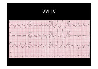 Pacemaker Mediated Tachycardia... or not? | PDF
