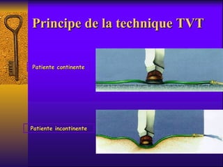 Principe de la technique TVT Patiente continente Patiente incontinente 