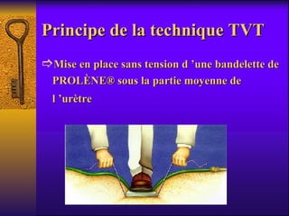 Principe de la technique TVT  Mise en place sans tension d ’une bandelette de PROLÈNE® sous la partie moyenne de l ’urètre 