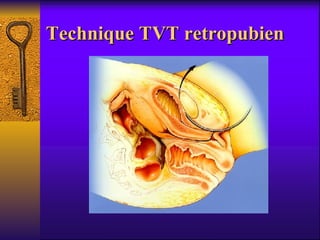 Technique TVT retropubien 