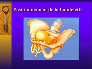 Positionnement de la bandelette 