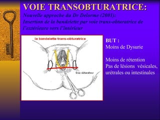 VOIE TRANSOBTURATRICE:  Nouvelle approche du Dr Delorme (2001):  Insertion de la bandelette par voie trans-obturatrice de l’extérieure vers l’intérieur BUT : Moins de Dysurie  Moins de rétention Pas de lésions  vésicales, urétrales ou intestinales 