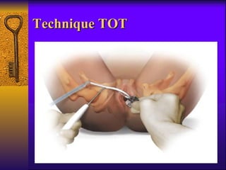 Technique TOT 