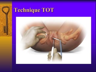 Technique TOT 
