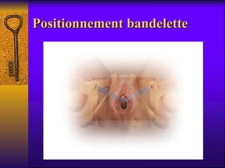 Positionnement bandelette 