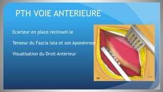 PTH VOIE ANTERIEURE
Ecarteur en place réclinant le
Tenseur du Fascia lata et son Aponévrose
Visualisation du Droit Antérieur
 