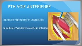 PTH VOIE ANTERIEURE
Incision de l’aponévrose et visualisation
du pédicule Vasculaire Circonflexe Antérieur
 