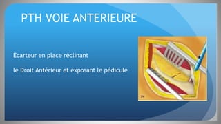 PTH VOIE ANTERIEURE
Ecarteur en place réclinant
le Droit Antérieur et exposant le pédicule
 