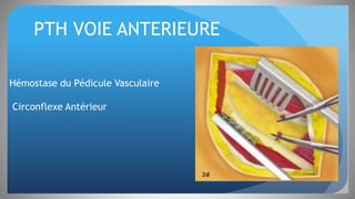 PTH VOIE ANTERIEURE
Hémostase du Pédicule Vasculaire
Circonflexe Antérieur
 