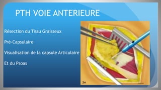 PTH VOIE ANTERIEURE
Résection du Tissu Graisseux
Pré-Capsulaire
Visualisation de la capsule Articulaire
Et du Psoas
 