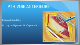 PTH VOIE ANTERIEURE
Incision Capsulaire
le Long du Ligament Ilio-Capsularis
 