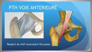 PTH VOIE ANTERIEURE
Respect du chef musculaire ilio-psoas
 