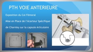 PTH VOIE ANTERIEURE
Exposition du Col Fémoral
Mise en Place de l’écarteur Spécifique
de Charnley sur la capsule Articulaire
 