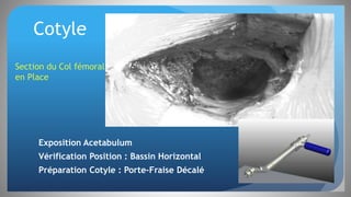 Cotyle
Exposition Acetabulum
Vérification Position : Bassin Horizontal
Préparation Cotyle : Porte-Fraise Décalé
Section du Col fémoral
en Place
 