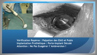 Cotyle
Vérification Repères : Palpation des EIAS et Pubis
Implantation Prothétique : Porte-Implant Décalé
Attention : Ne Pas Exagérer l’ Antéversion !
 