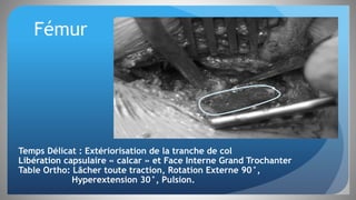 Fémur
Temps Délicat : Extériorisation de la tranche de col
Libération capsulaire « calcar » et Face Interne Grand Trochanter
Table Ortho: Lâcher toute traction, Rotation Externe 90°,
Hyperextension 30°, Pulsion.
 